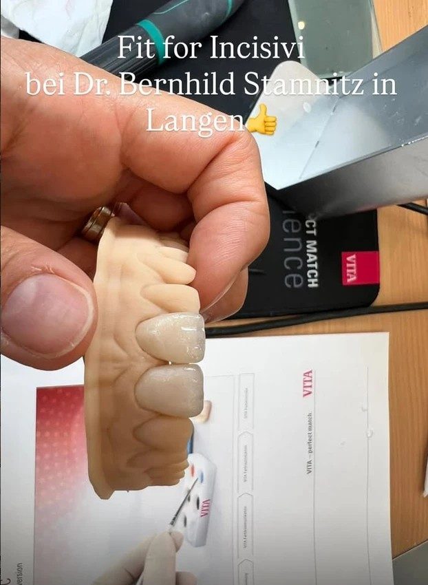Im Kurs gefertigte Frontzahnkronen auf dem Modell